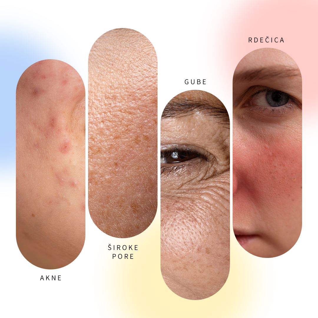 Skin issues: acne, pores, wrinkles, redness